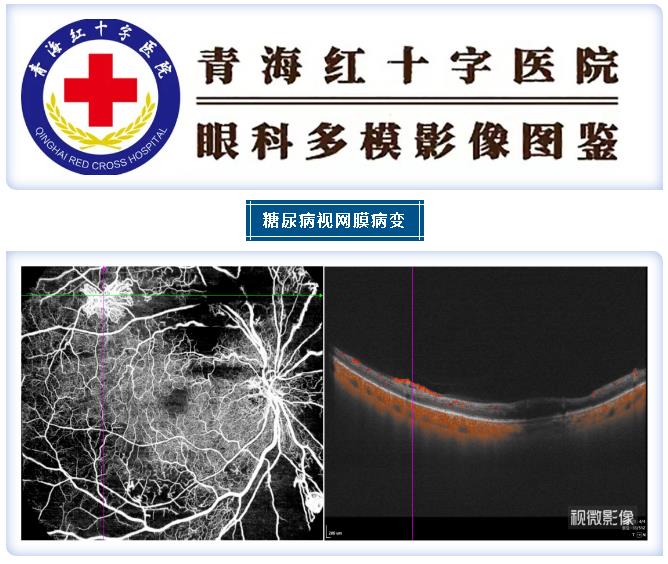 【眼科图鉴】多模影像图鉴第十一期——糖尿病视网膜病变