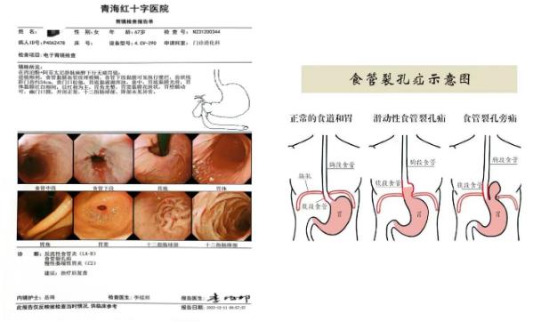 内镜移疝，食管裂孔疝治疗有办法——青海红十字医院消化内镜室成功完成一例食管裂孔疝套扎治疗术