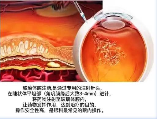 【眼科图鉴】多模影像图鉴第十八期——糖尿病黄斑水肿(DME)